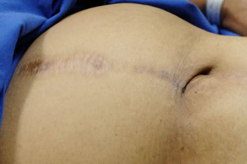 6 Penyebab Bekas Operasi Hernia Terasa Sakit, Ini yang Perlu Diketahui (1).jpg