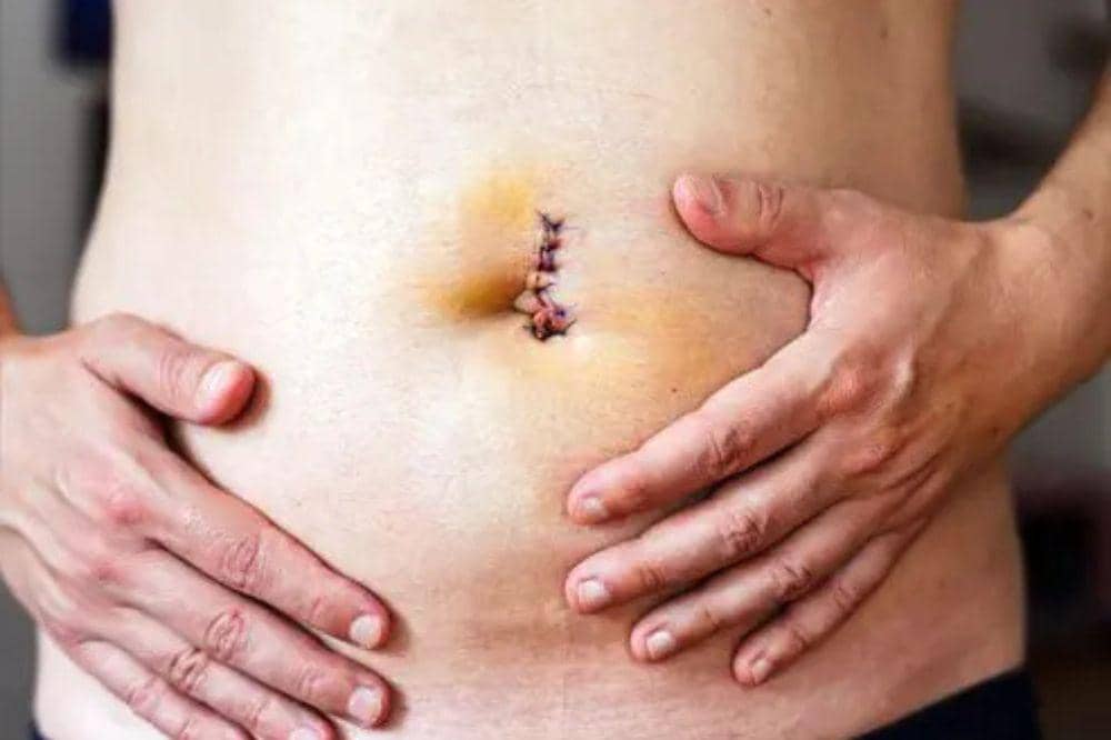6 Penyebab Bekas Operasi Hernia Terasa Sakit, Ini yang Perlu Diketahui (3).jpg