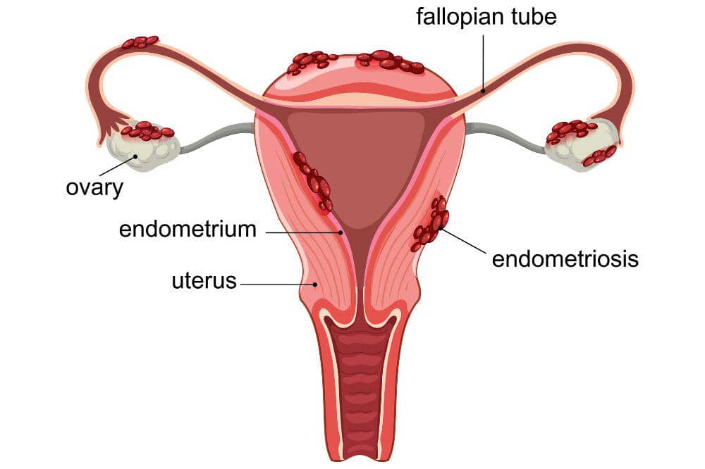 Perbedaan Kista-Miom-Endometriosis 1.jpg