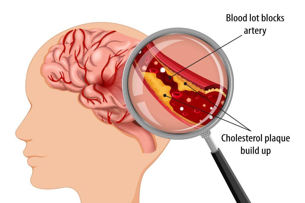 Apakah Stroke Bisa Sembuh? Selalu Ada Harapan Kembali Sehat