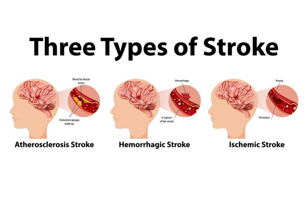 6 Penyebab Stroke Ringan, Jarang Olahraga Salah Satunya