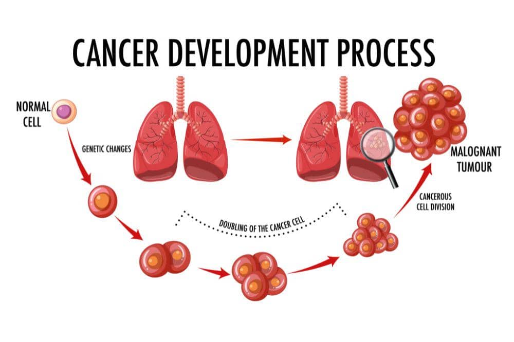 Apakah Kanker Paru-Paru Bisa Sembuh? Ini Pilihan Terapi dan Harapannya