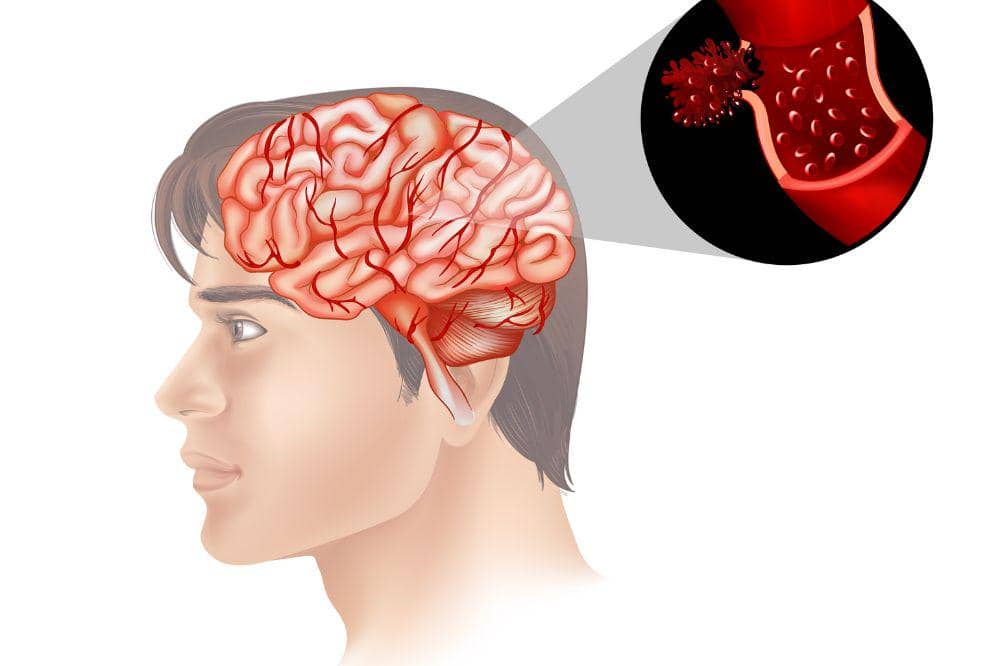 Apa itu Stroke Non Hemoragik? Begini Gejala dan Penyebabnya