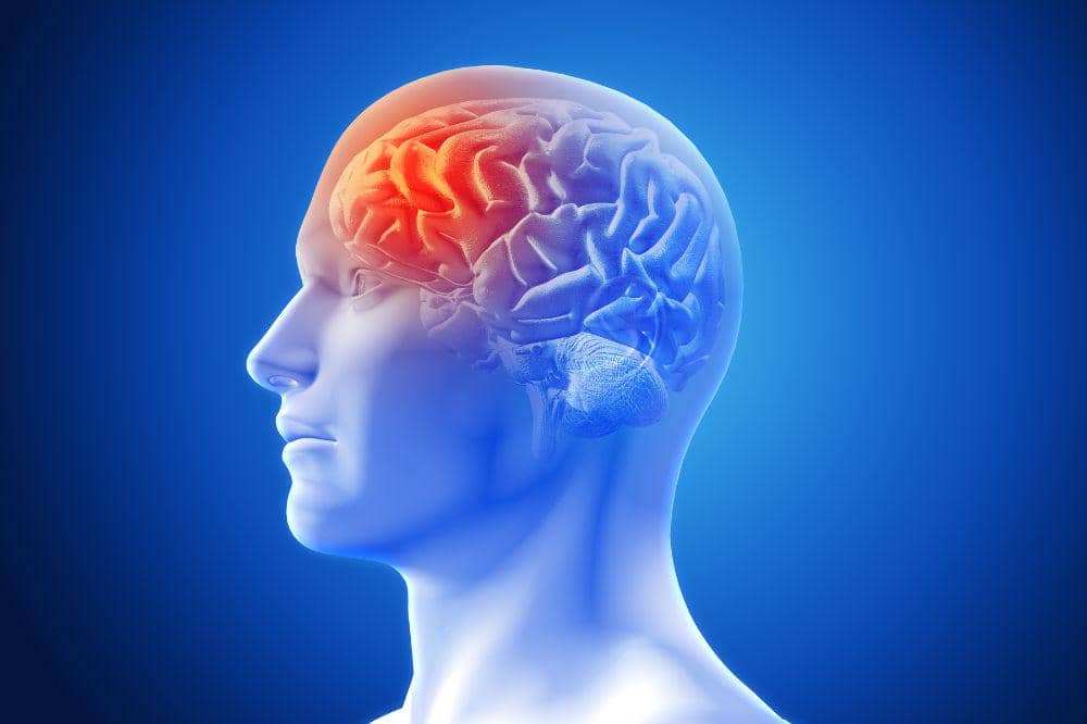 Apa Itu Stroke Infark Ini Gejala, Penyebab dan Penanganannya.jpg