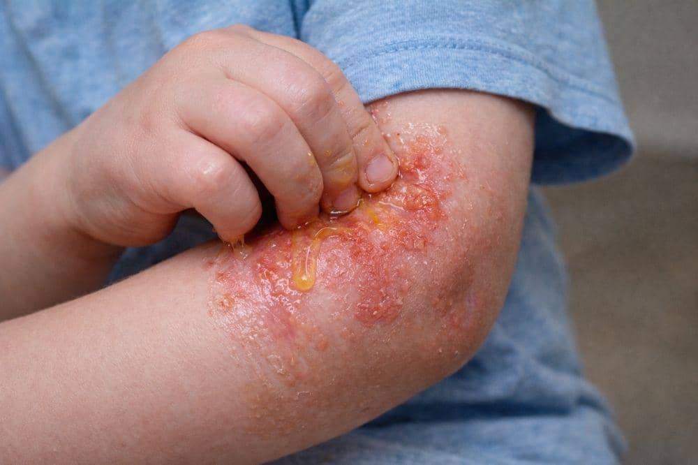 5 Contoh Eksim Basah beserta Ciri-Cirinya