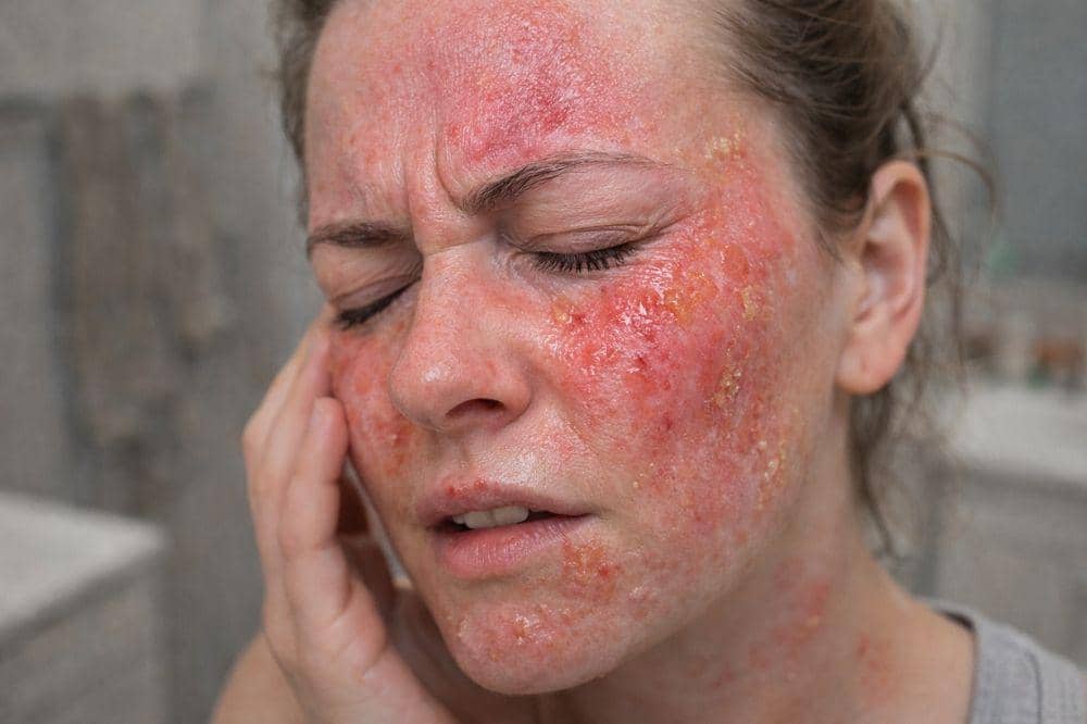 5 Contoh Eksim Basah beserta Ciri-Cirinya