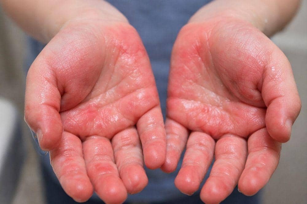 5 Contoh Eksim Basah beserta Ciri-Cirinya