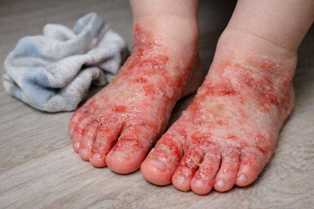 5 Contoh Eksim Basah beserta Ciri-Cirinya