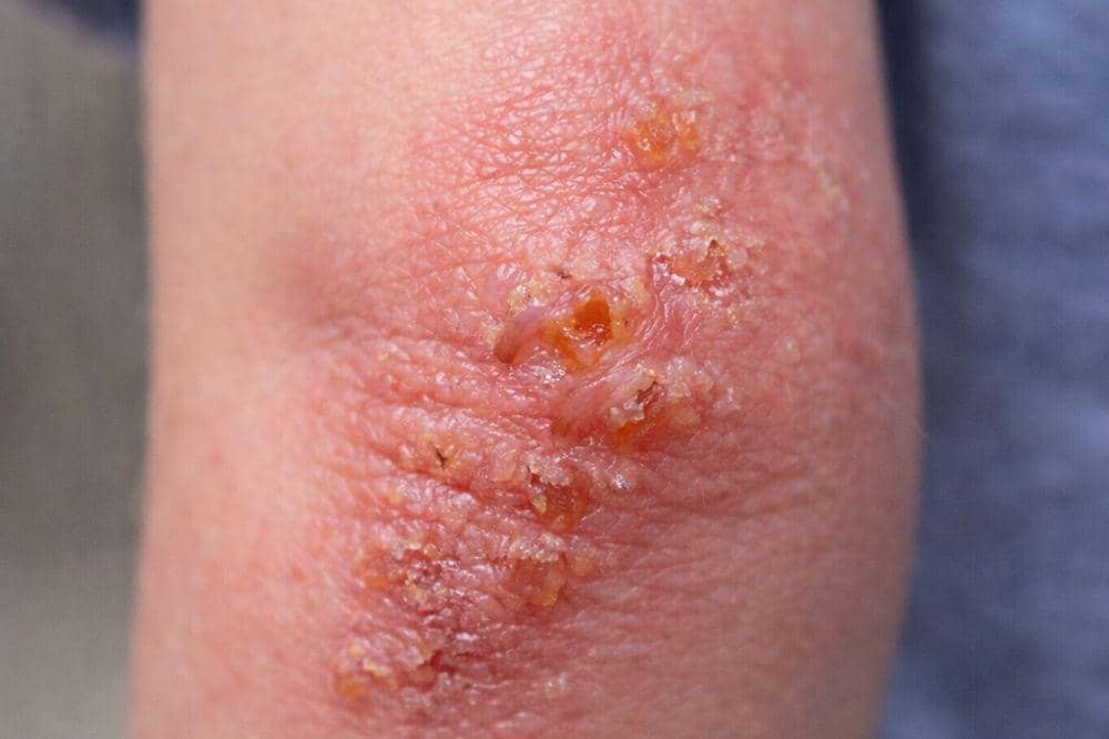 5 Contoh Eksim Basah beserta Ciri-Cirinya