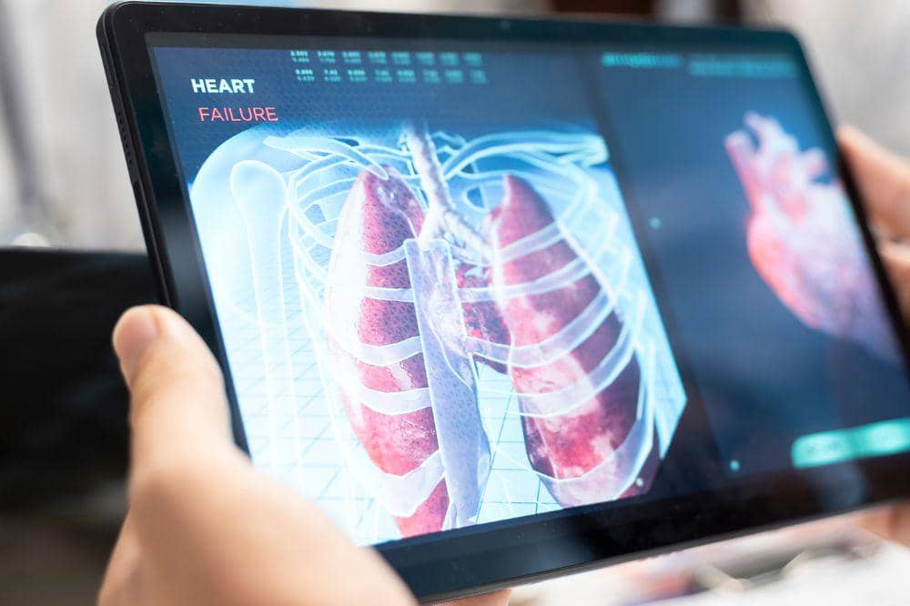 Apakah Kanker Paru-Paru Stadium 3 Bisa Sembuh Total? Ini Kata Medis