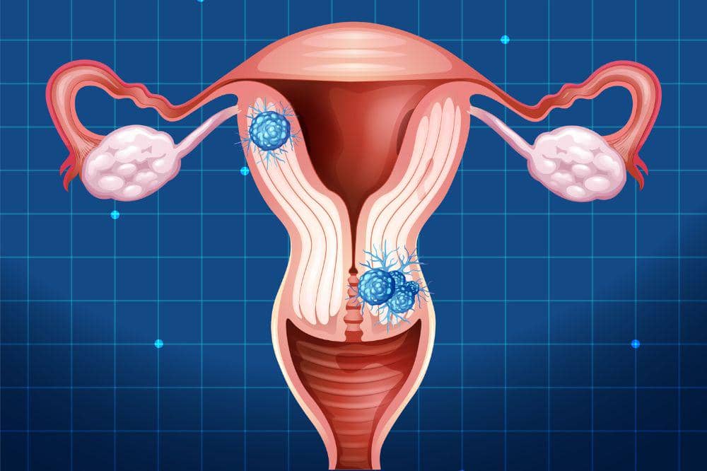 3 Jenis Kanker Ovarium Stadium 4 Berdasarkan Tipe Selnya