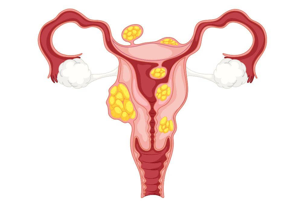 3 Jenis Kanker Ovarium Stadium 4 Berdasarkan Tipe Selnya