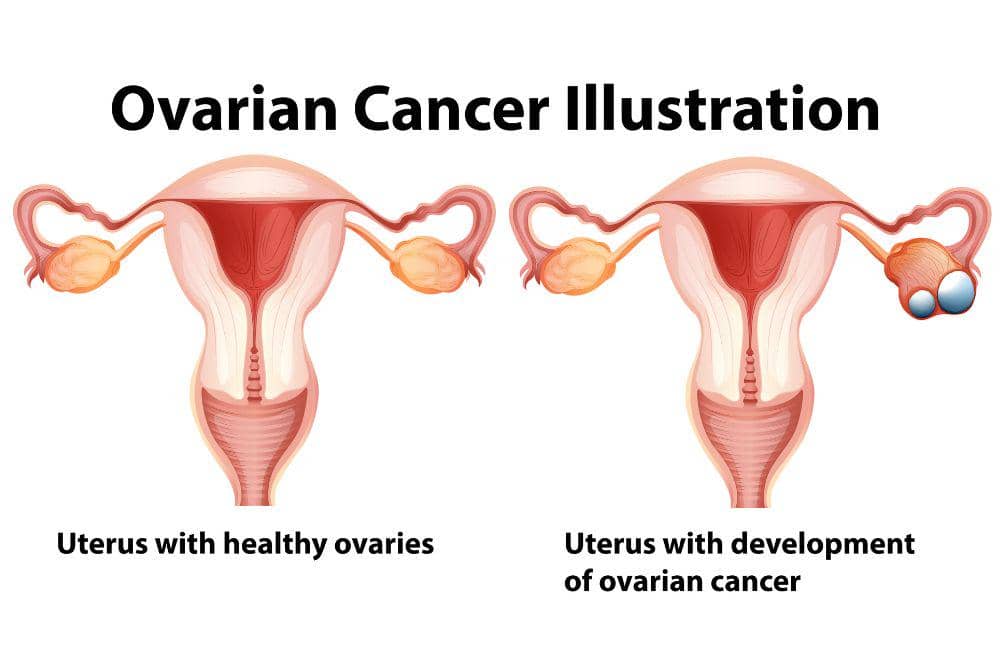 3 Jenis Kanker Ovarium Stadium 4 Berdasarkan Tipe Selnya