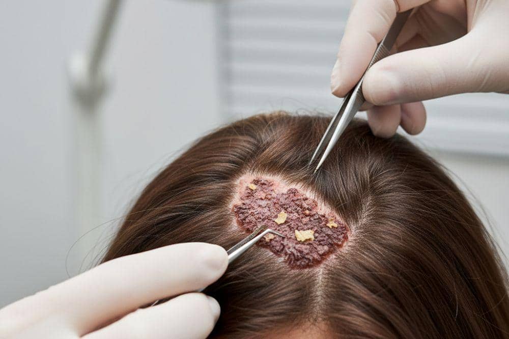 Kanker Kulit Kepala: Faktor Risiko, Penyebab, dan Pengobatan Medisnya