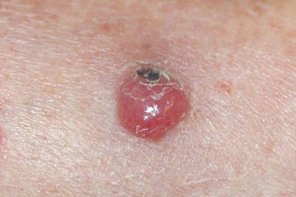 7 Jenis Kanker Kulit dan Gambarnya, Ciri Awal yang Sering Diabaikan!