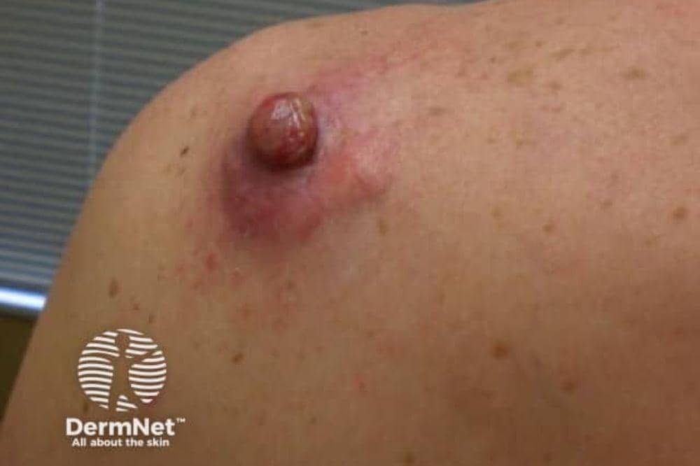 7 Jenis Kanker Kulit dan Gambarnya, Ciri Awal yang Sering Diabaikan!