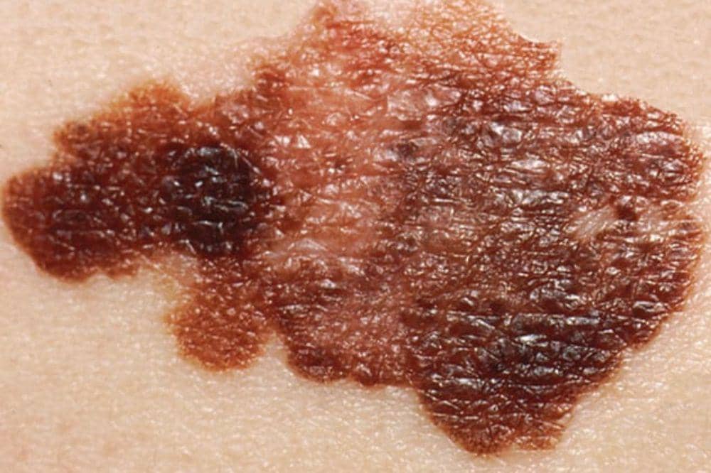 6 Gejala Kanker Kulit, Jangan Anggap Sepele Perubahannya