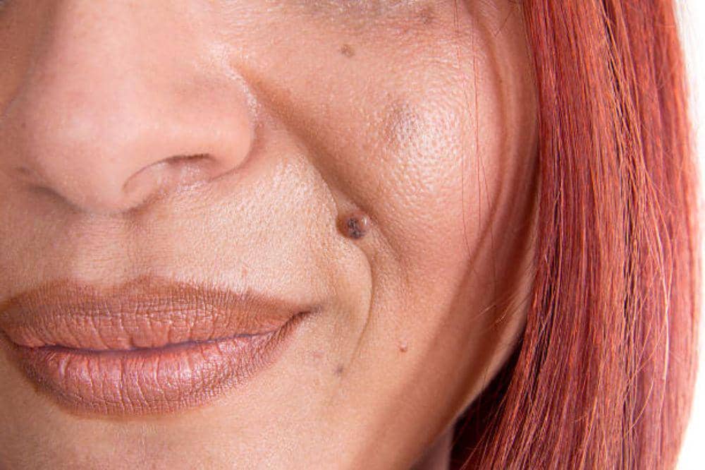 7 Ciri-Ciri Kanker Kulit Wajah dari Lesi hingga Luka Tak Sembuh