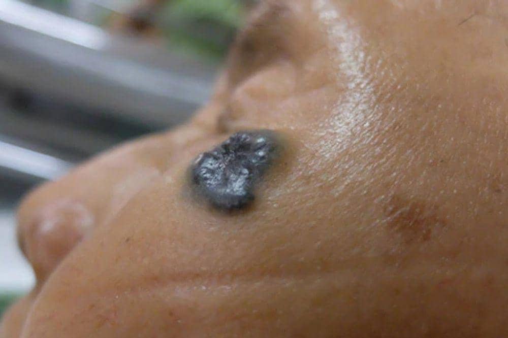 6 Gejala Kanker Kulit, Jangan Anggap Sepele Perubahannya (1).jpg