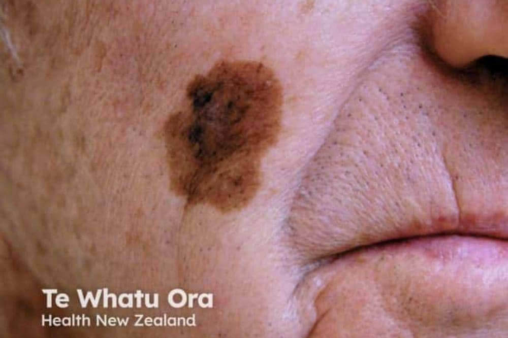 7 Jenis Kanker Kulit dan Gambarnya, Ciri Awal yang Sering Diabaikan!