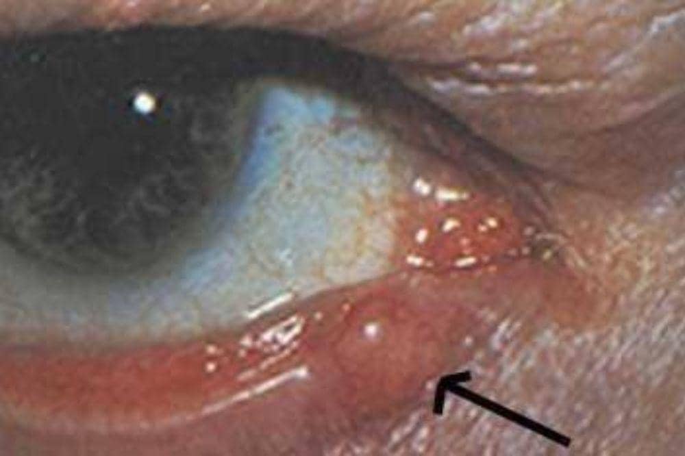 7 Jenis Kanker Kulit dan Gambarnya, Ciri Awal yang Sering Diabaikan!