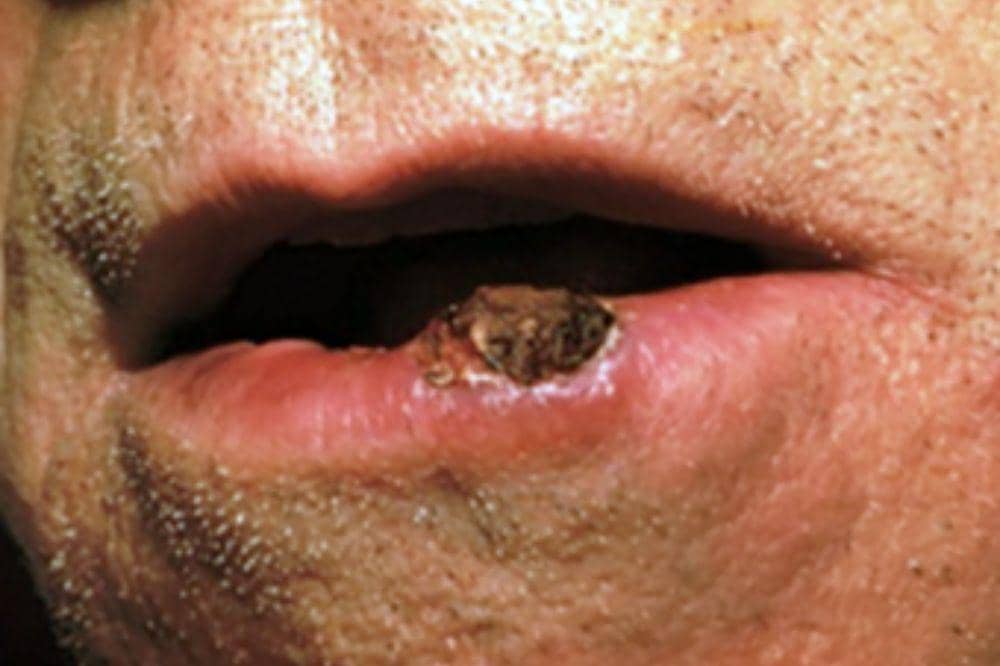 7 Jenis Kanker Kulit dan Gambarnya, Ciri Awal yang Sering Diabaikan!