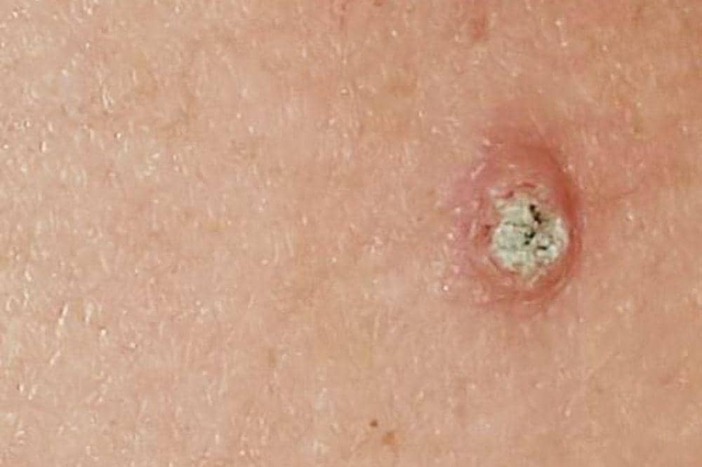 5 Tanda Kanker Kulit Stadium Awal yang Sering Dikira Masalah Biasa