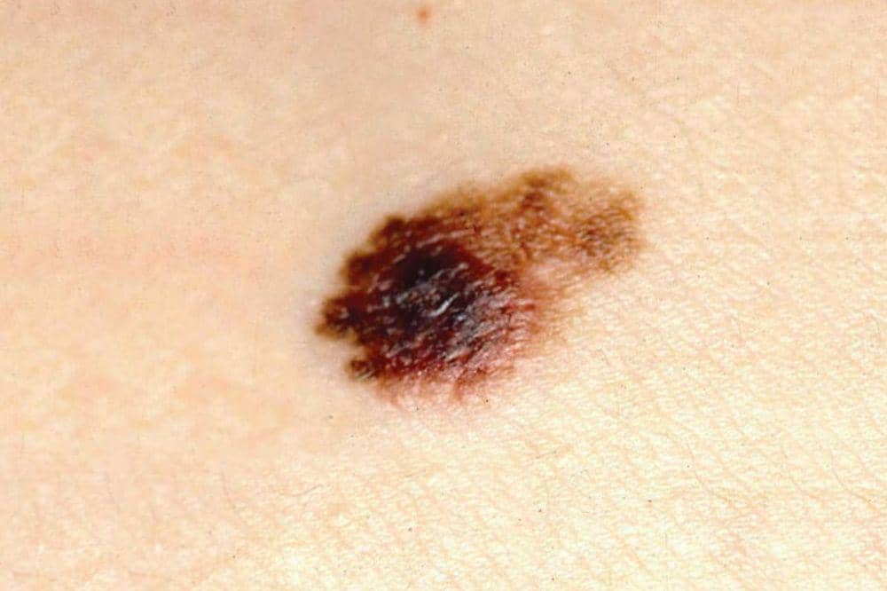 5 Ciri-Ciri dan Gambar Kanker Kulit Melanoma, Kenali Tanda Peringatan (1).jpg
