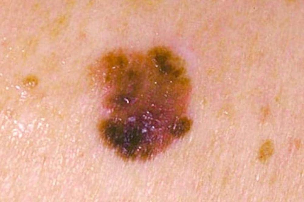 5 Ciri-Ciri dan Gambar Kanker Kulit Melanoma, Kenali Tanda Peringatan (3).jpg