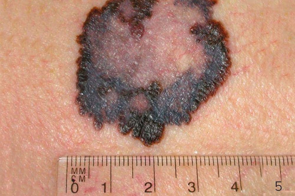 5 Ciri-Ciri dan Gambar Kanker Kulit Melanoma, Kenali Tanda Peringatan (6).jpg