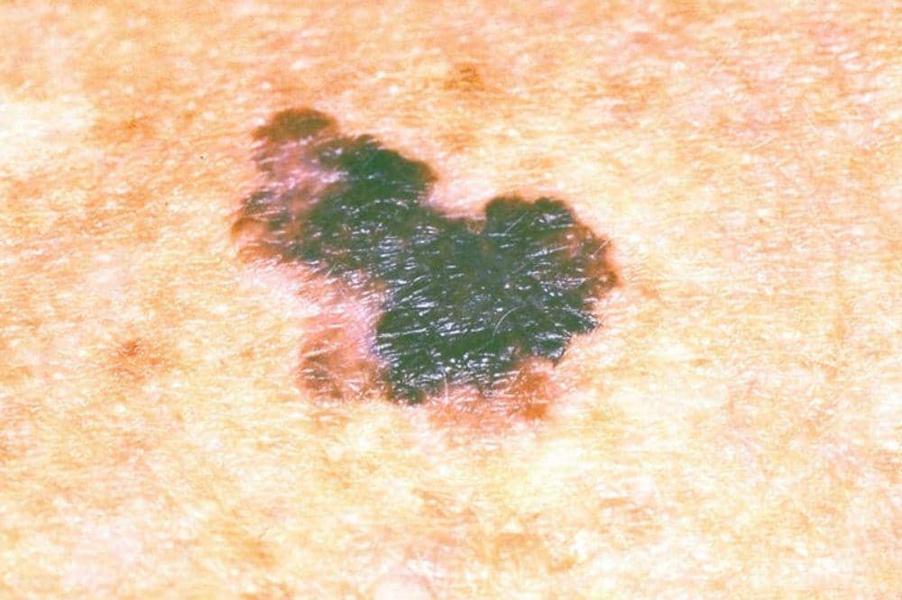 5 Ciri-Ciri dan Gambar Kanker Kulit Melanoma, Kenali Tanda Peringatan (2).jpg