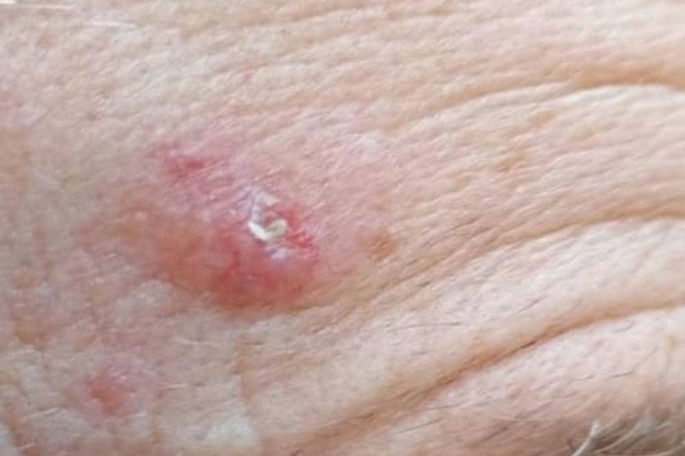 Apa Itu Kanker Kulit Karsinoma Sel Basal Ini Penyebab dan Gejalanya (1).jpg