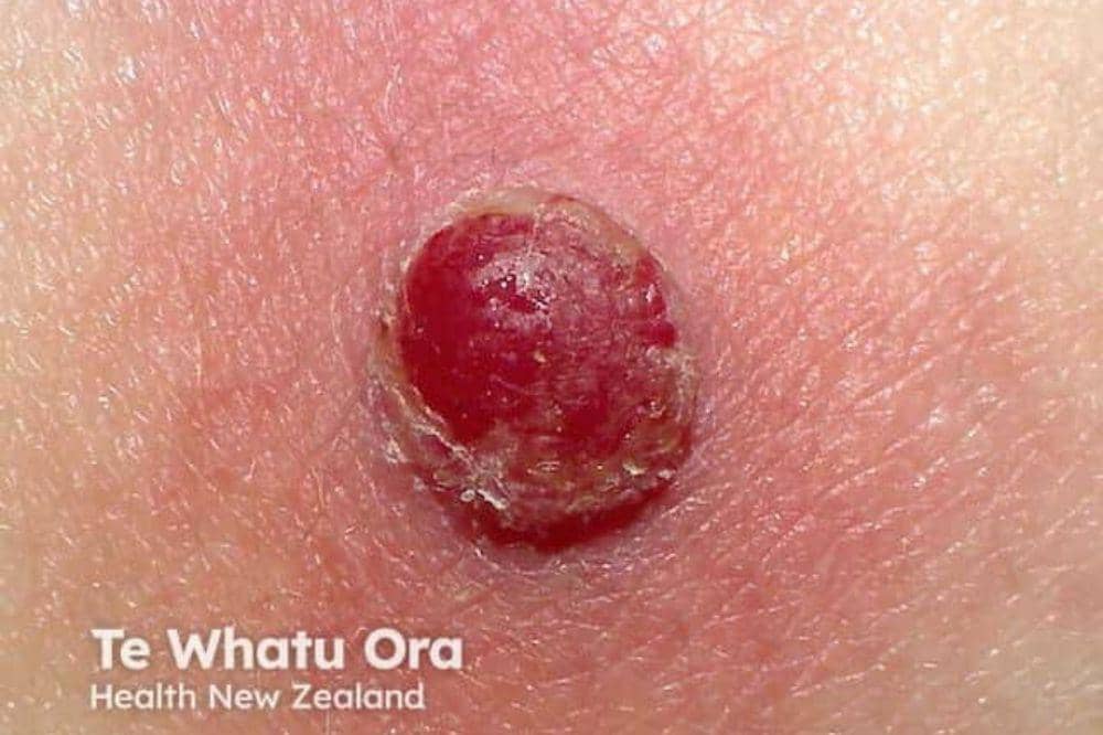 5 Tanda Kanker Kulit Stadium Awal yang Sering Dikira Masalah Biasa.jpg