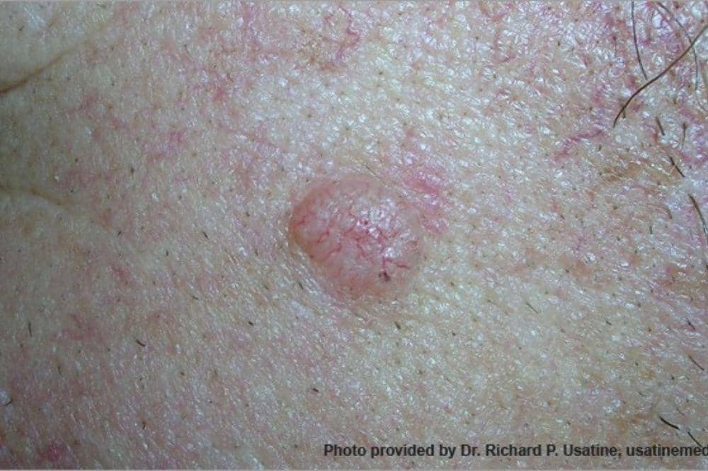 Apakah Kanker Kulit Bisa Sembuh? Jangan Panik Dulu, Ini Faktanya