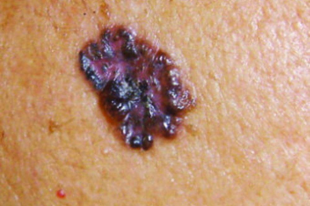 3 Jenis Kanker Kulit di Kaki, Kenali Ciri Awal dan Risikonya