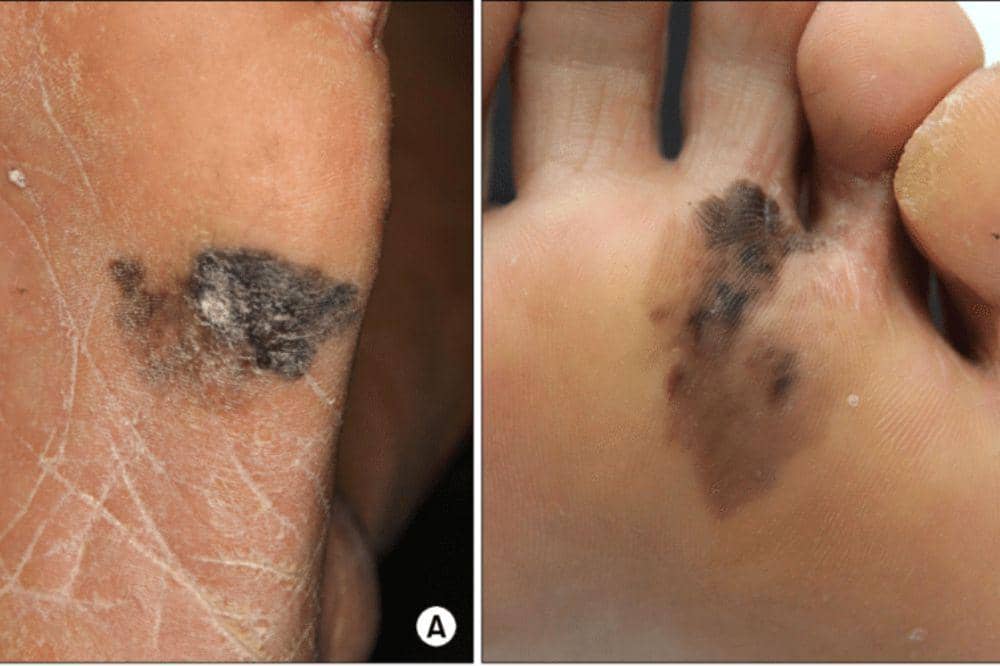 3 Jenis Kanker Kulit di Kaki, Kenali Ciri Awal dan Risikonya