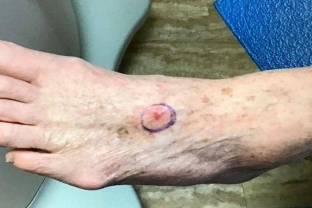 3 Jenis Kanker Kulit di Kaki, Kenali Ciri Awal dan Risikonya