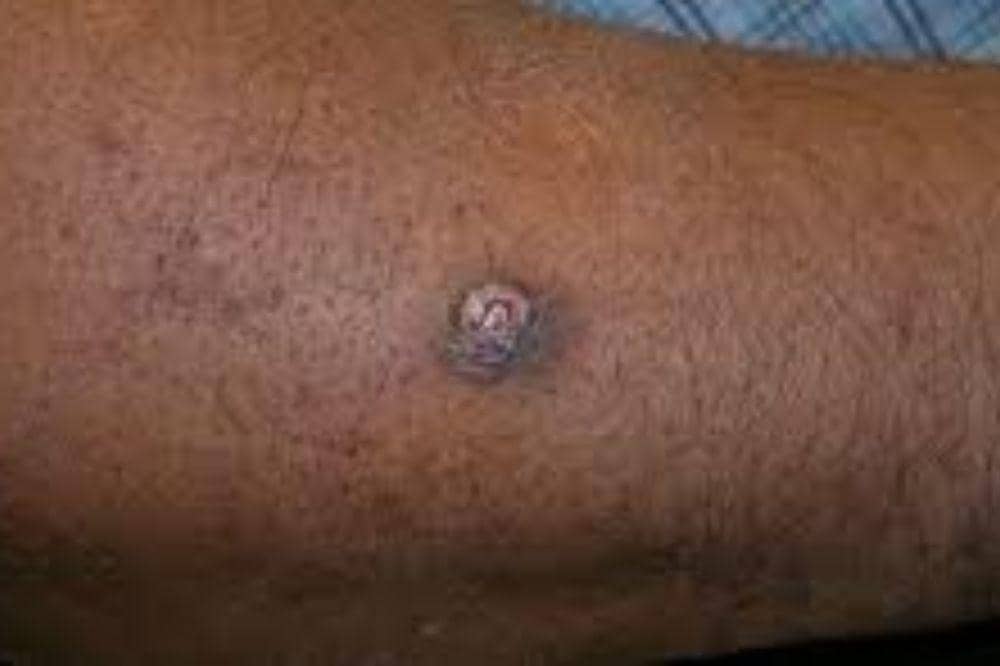 3 Jenis Kanker Kulit di Kaki, Kenali Ciri Awal dan Risikonya