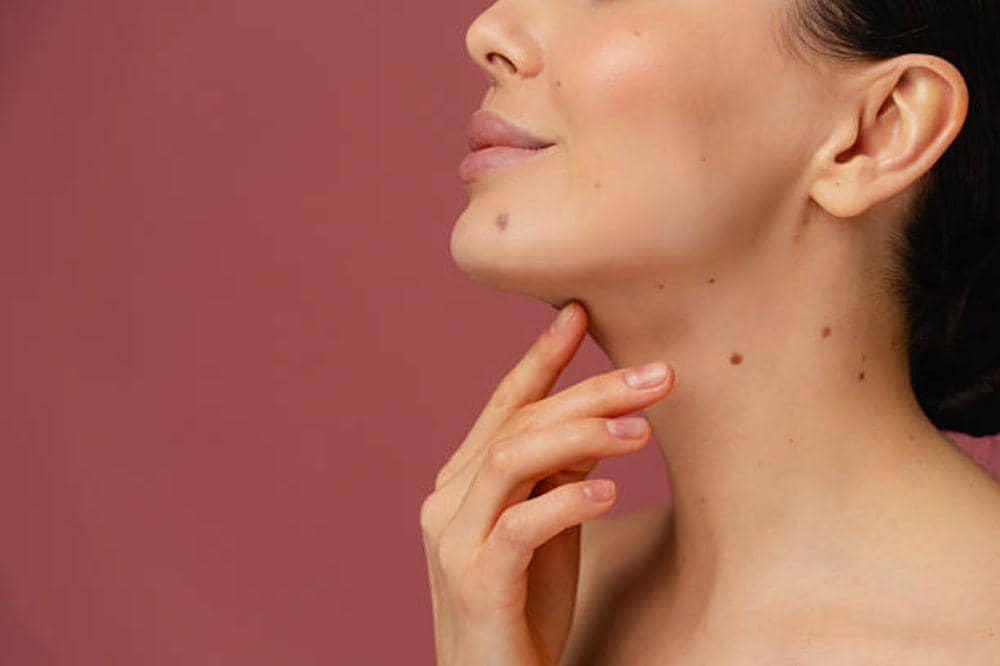 8 Perbedaan Tahi Lalat dan Kanker Kulit yang Sering Keliru!