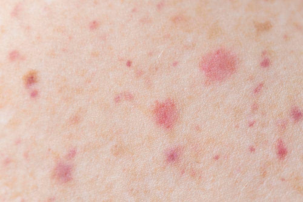 8 Gejala Herpes Kulit dari Ringan hingga Parah