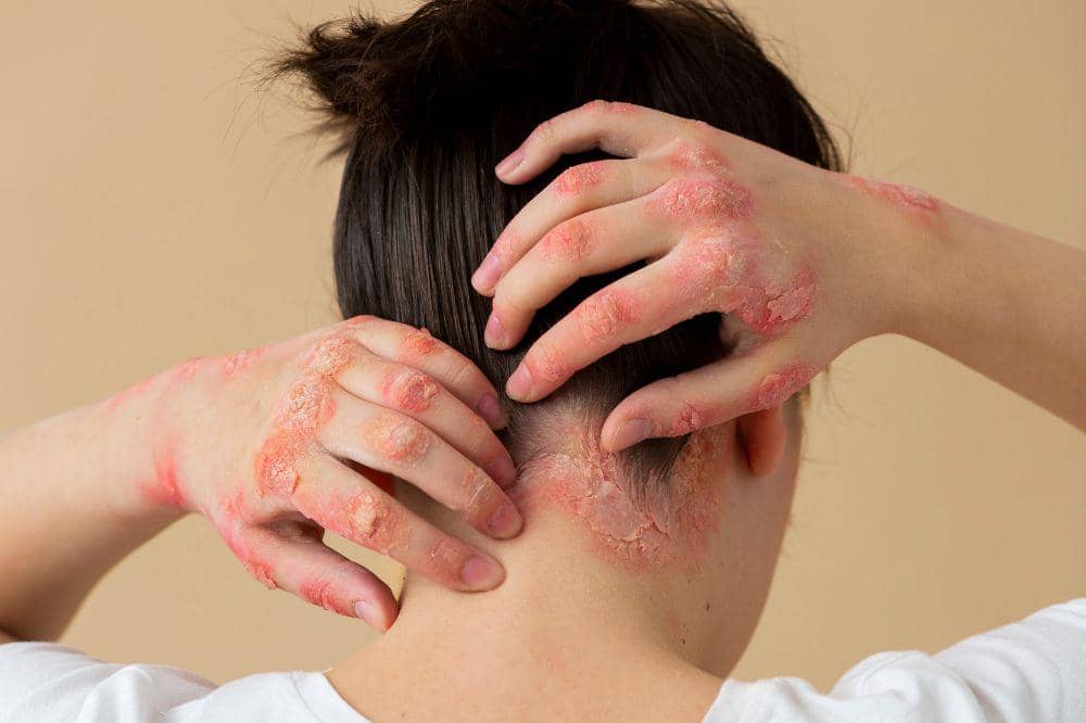 8 Gejala Herpes Kulit dari Tanda Ringan hingga Parah