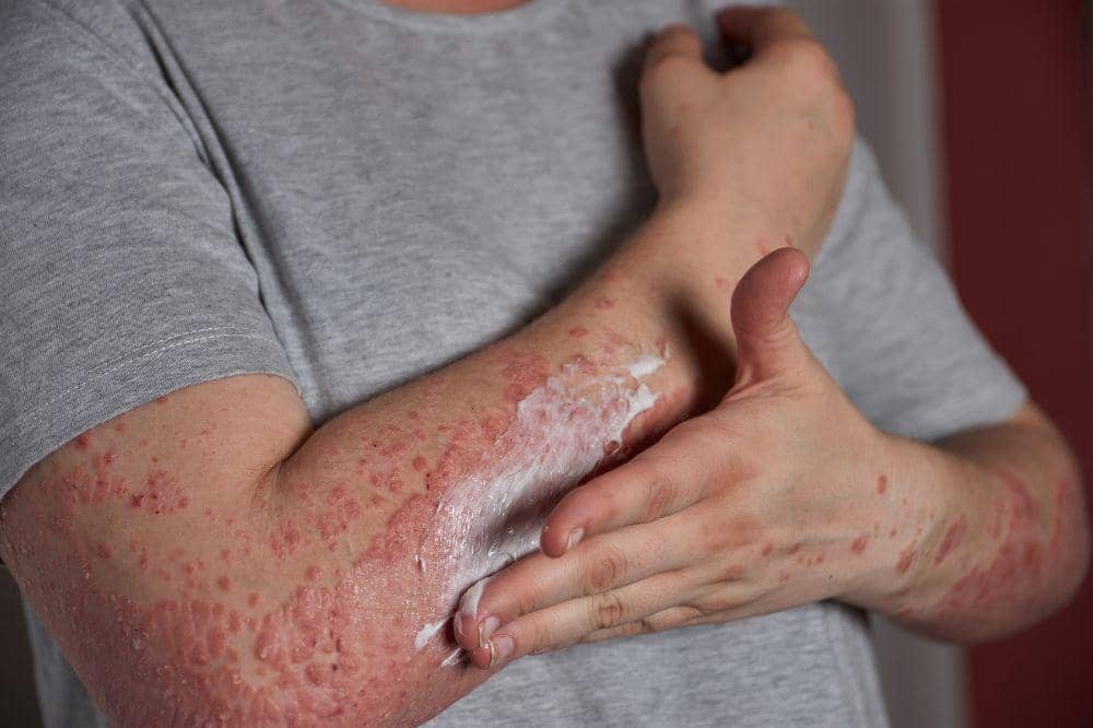 8 Gejala Herpes Kulit dari Ringan hingga Parah