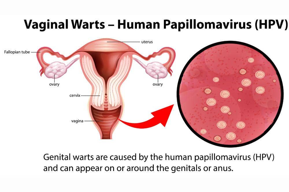 Penting diketahui punya virus hpv bukan berarti terkena kanker serviks