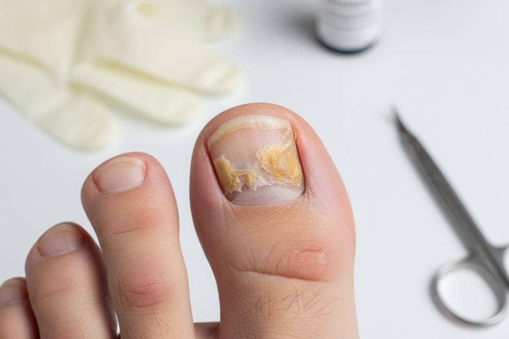 5 Jenis Infeksi Jamur di Kulit dan Cara Mengatasinya