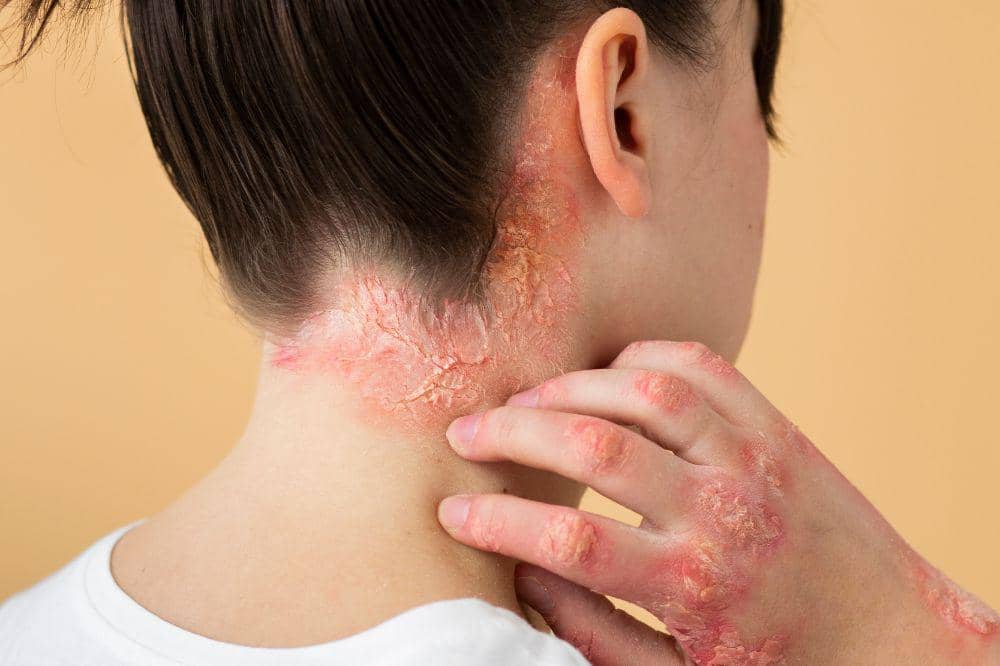 Apa Itu Dermatitis Seboroik? Ini Penjelasannya