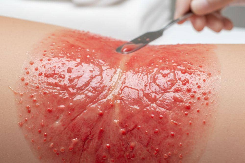 5 Jenis Infeksi Jamur di Kulit dan Cara Mengatasinya