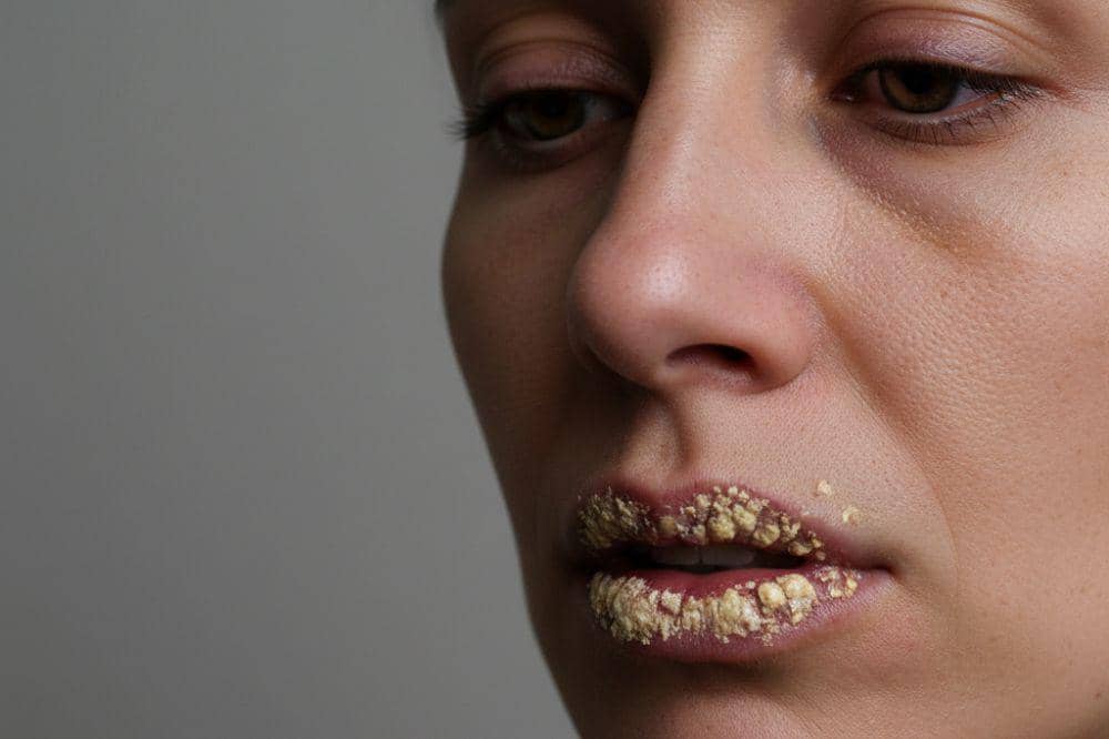 Benarkah Sering Mengelupas Bibir Tanda Gangguan Psikologis? Hati-Hati!