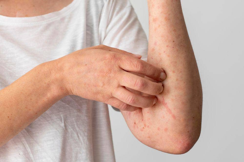 Apa Itu Dermatitis Seboroik? Ini Penjelasannya
