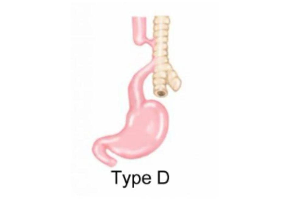 Mengenali atresia esofagus kelainan bawaan pada bayi 