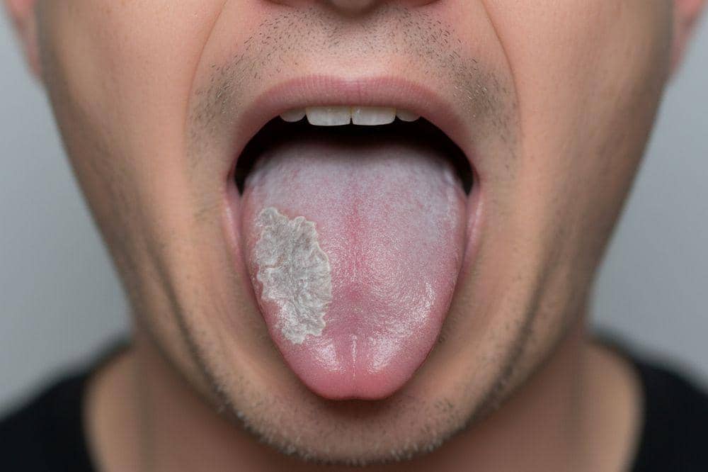 8 Penyebab Lidah Putih pada Orang Dewasa dan Cara Mengatasinya